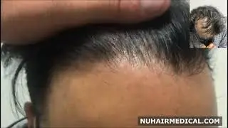 3000 Grafts FUE Hair Transplant in Edmonton