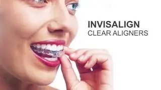 Straighten your teeth with  Invisalign in Dubai (Invisible and Removable Braces)