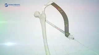 APFN Lag Screw Cement procedure
