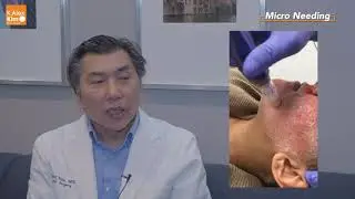 Microneedling with PRP or without PRP by Alex Kim M.D.