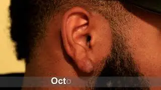 Altering the Biology and Clinical Behavior of Keloids with Cryotherapy