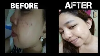 Skinmate Shark oil/Skinmate Placenta Cream Review