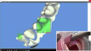 Scanner intraorale 3D Progress