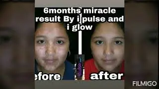Indusviva I Glow review| leucoderma|सफेद दाग