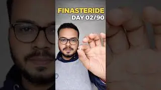 Finasteride Day 02 | My Hair Regrowth Journey | Whote flakes Solution #finasteride #hairloss #shorts