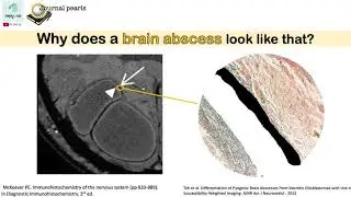 Brain abscess vs glioblastoma - dual rim sign on MRI