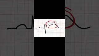 STEMI Mimic: Brugada Syndrome