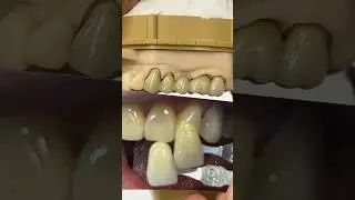Metal Ceramic Bridge @EnvisiontecMain #envisiontec #lsk121shorts #teeth #dental