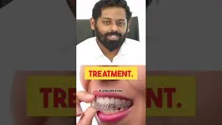 Clear Aligner in Kerala | Clear Aligner | Invisible braces Kerala #clearalignerskerala