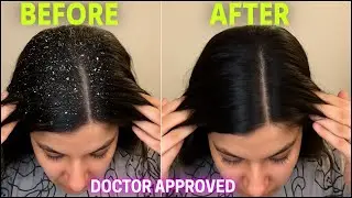 Dandruff Ko Jarr Se Khatam Karne Ki Scientific Home Remedy | Dandruff treatment at home | Dr Madiha