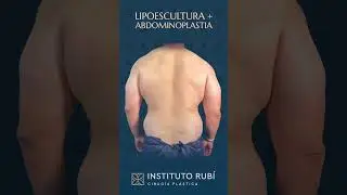 Resultado antes y despu&eacute;s de cirug&iacute;a pl&aacute;stica de lipoescultura con abdominoplastia