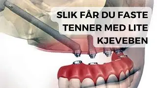 Hva når kjeveben er for lite for tannimplantat? Er alt håp ute?