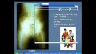 Children and Leg Length Inequality