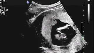 2D Echo 13 Weken Geslachtsbepaling Jongen, met ingesproken uitleg