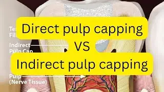 DIRECT VS INDIRECT pulp capping