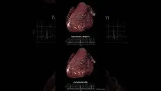 Atrial Fibrillation (AF)