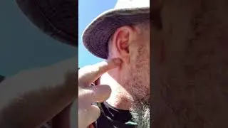 Number 2 skin cancer going to be cut out 