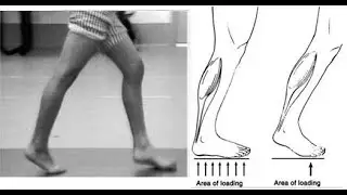 Contracture Gait; Hip flexion , Ankle equinus, Knee flexion contracture gait   joints held in fixed,