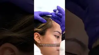 Botox for Hairloss (repeat)