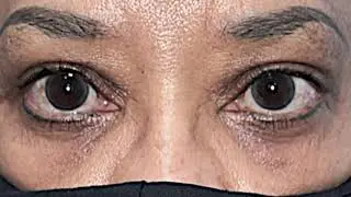 Upper blepharoplasty, brow-fat pexy, and canthoplasty with Dr. John Burroughs in Colorado Springs