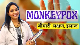 Monkeypox Virus Disease, Symptoms, Treatment and Vaccine in Hindi