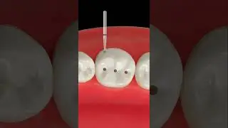 Class-1 Cavity preparation|#cavity#cavityprevention#cavityfilling#dentaleducation#drswastislife