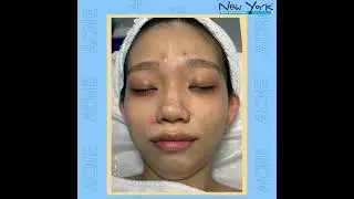 CICA BLEMISH -  A Guaranteed Solution for Acne Skin!