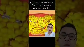 Lipoaspira&ccedil;&atilde;o Tumescente