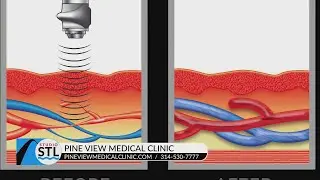 Pine View Medical Clinic offers needle and surgery-free solution to E.D.