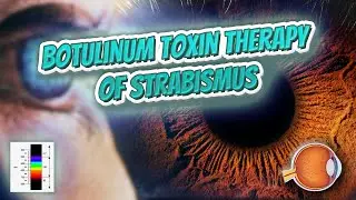 Botulinum toxin therapy of strabismus - Your EYEBALLS - EYNTK 👁️💉😳💊🔊💯✅