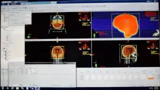 Radioterapia tecnica subcampos (subfield Radiotherapy Technique)