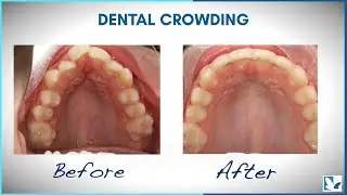 How To Treat Moderately Severe Dental Crowding?