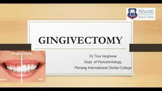 Gingivectomy