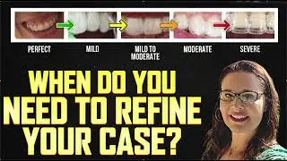 Tracking Nightmares for Invisalign and Clear Aligners- When to Refine