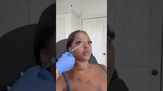 Under eye filler treatment for under eye bags 💉#shortsfeed