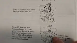 This is how enlarged facet joints can cause spinal stenosis.