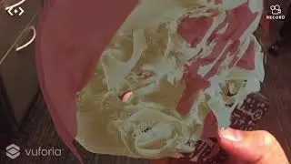 Congenital ear anomaly in Augmented Reality