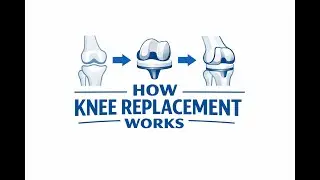 HOW KNEE REPLACE WORKS