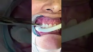 Applying Desensitizing Paste on Roots to Minimize Teeth Sensitivity | In Office to Hands On Dental