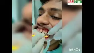 How Invisalign Attachments are placed? #shorts #ytshorts #aligner