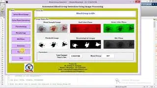 Blood Group Detection Using Image Processing Matlab Project Source Code | Blood Group Classification