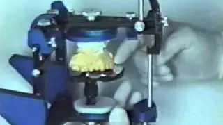 Kois System- Mounting by Panadent