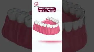 Teeth Alignment with Clear Aligners 3D Animation #shorts