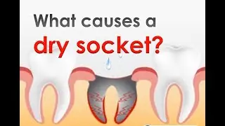 Dry Socket/ Alveolar Osteitis I Prevention and Treatment I Oral Surgery I Dental Guide I