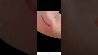 Локтевой туннельный синдром. Синдром кубитального канала.