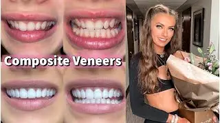 Smile Transformation - Composite Veneers