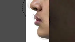 Post-Cleft Lip Deformity Correction with Fat Micrografting | Dr. Rajesh Vasu | Best Plastic Surgeon