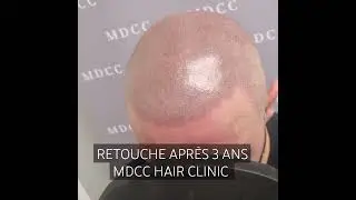 Retouche apr&egrave;s 3 ans.MDCC Look ras&eacute; ultra r&eacute;aliste. #calvitie #greffecheveux #hairstyle