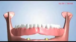 Treatment Options for All Missing Teeth in San Diego