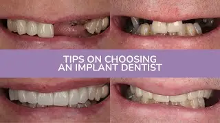 Tips On Choosing An Implant Dentist